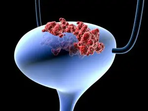 Bladder cancer