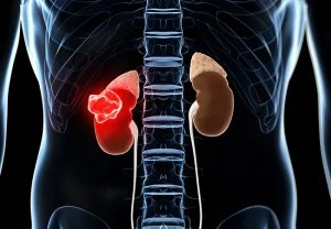 Kidney cancer