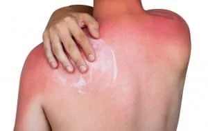 Sunburned skin